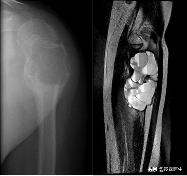 骨头里的泡沫——动脉瘤样骨囊肿