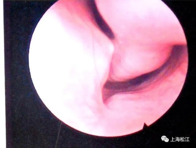 打鼾|你睡觉打呼噜吗？这种情况很危险