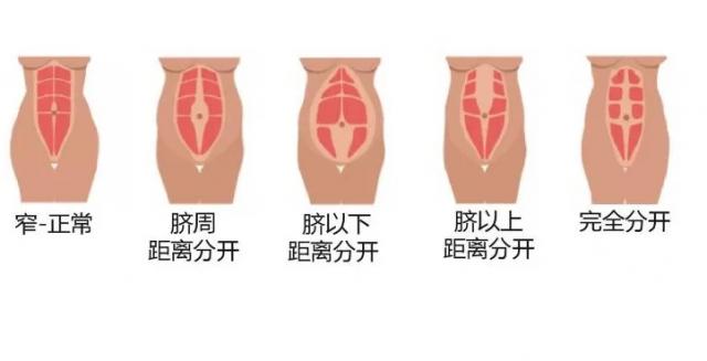 超级宝妈@拜拜“大肚腩”，嗨喽“小蛮腰”——神奇的腹直肌分离治疗