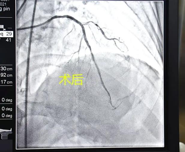 重磅！心脏冠脉支架7500元降至590元，在宝鸡高新医院率先执行