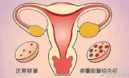 内分泌|女性最常见的内分泌疾病：多囊卵巢综合征