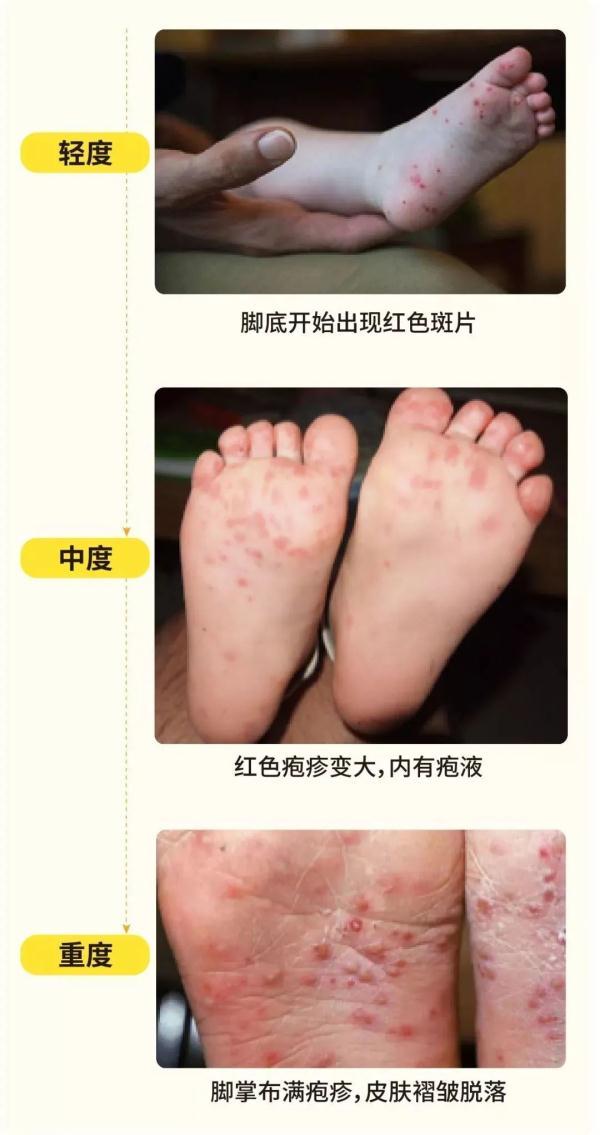 手足|发现孩子手脚出现这种情况要当心了，这种无特效药的传染病正高发