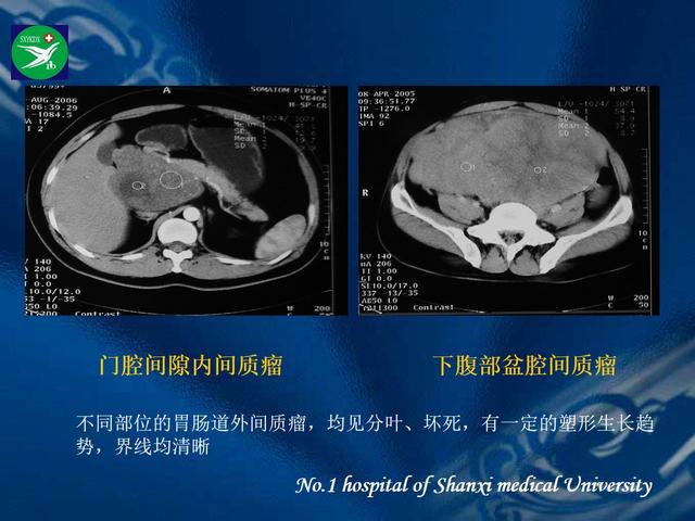 李健丁教授：胃肠道外间质瘤的CT表现和临床病理分析