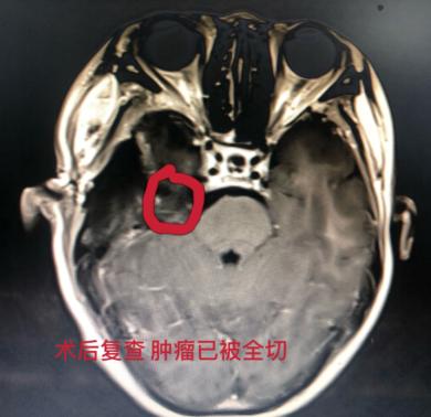 两次成功除瘤 老人感激送锦旗