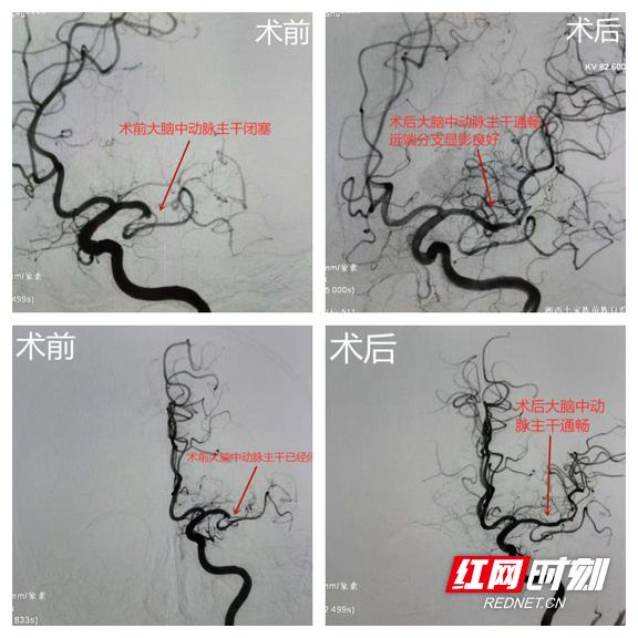 治疗|学史力行 祛病为民——湘西州人民医院神经外二科成功开展湘西州第一例颅内动脉慢性闭塞开通术