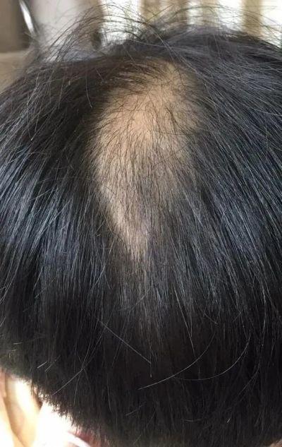 冲动性|“10后”也秃了？台州两个小学生不断脱发，查了半天，真相是这个