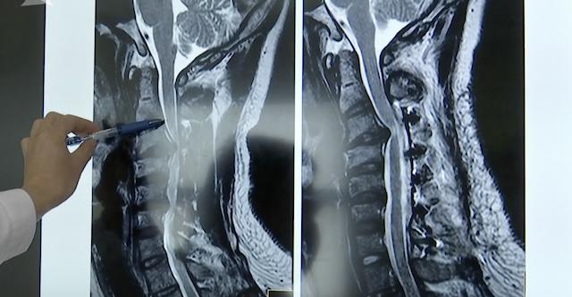 26岁却有60岁的脊椎！小伙脊髓薄如纸片差点瘫痪