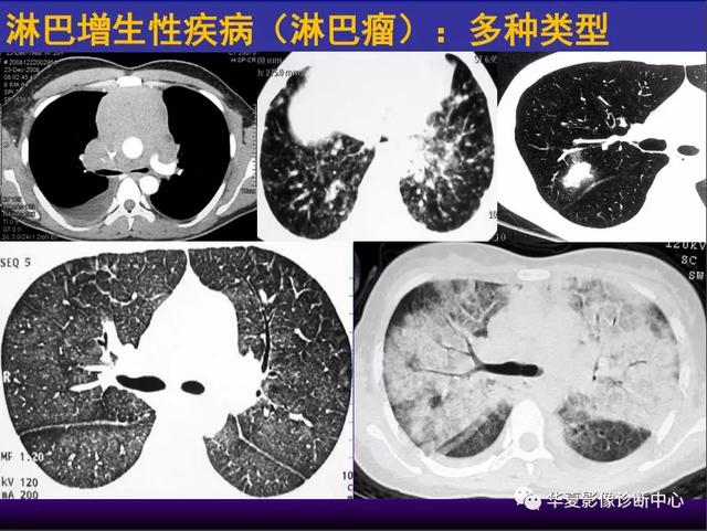 肺间质性疾病的解剖、病理、影像分析