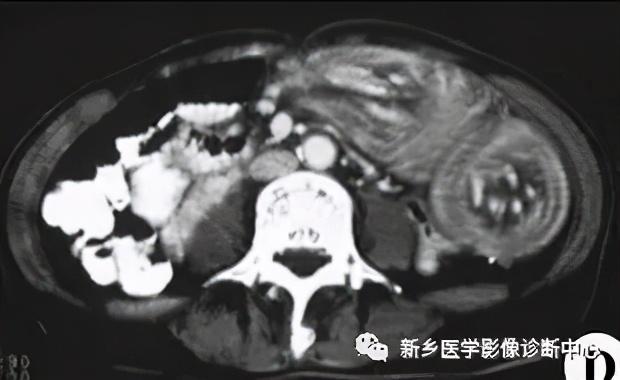 夜间值班腹部疼痛原因影像表现，值得收藏