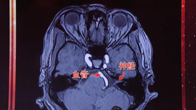 眼皮跳财运到？当心是一种特殊高血压！专家：用一块棉垫就能治愈