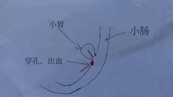 医生|太稀奇了！18岁男子腹痛难忍，一查发现肠子里竟然长了个……