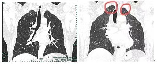 赵大姐|“肺”竟跑到了脖子里？杭州大姐越想越慌：8年了，该怎么办......