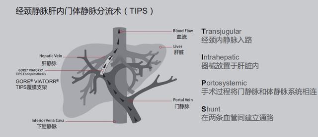 南昌大学第二附属医院消化内科2020年TIPS首破百例再创新高