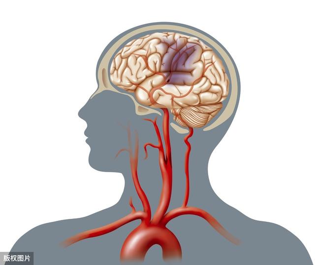 30%的脑梗死和颈动脉斑块有关，坚持做好斑块防治刻不容缓