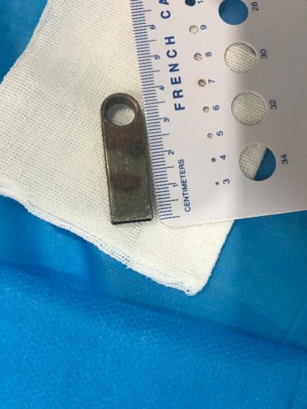 [光明网]险！3岁女孩贪玩误吞U盘 异物不及时取出小心“穿孔”
