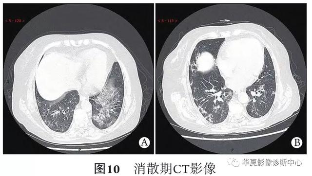 「影像进展」新冠肺炎的CT典型和不典型表现以及影像学分期