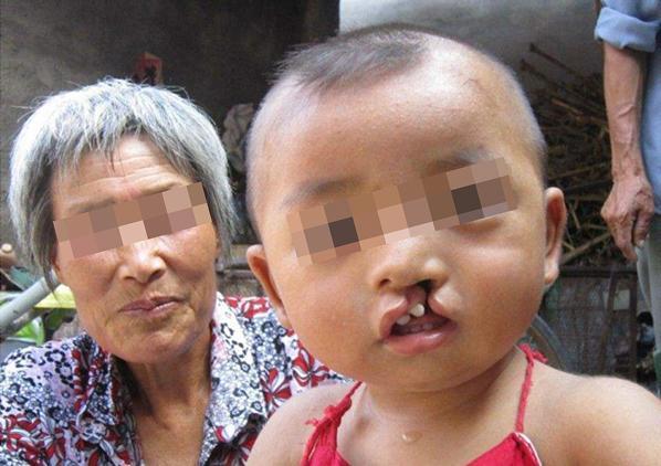 超级宝妈@导致婴儿出现兔唇的四大原因，孕妇不得不了解！
