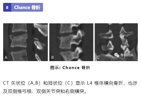 影像经验！脊柱的 13 个影像学特征