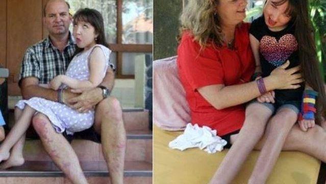 超级宝妈：为了让11岁女儿不再生长，父母选择摘掉她的子宫，称都是为了她好