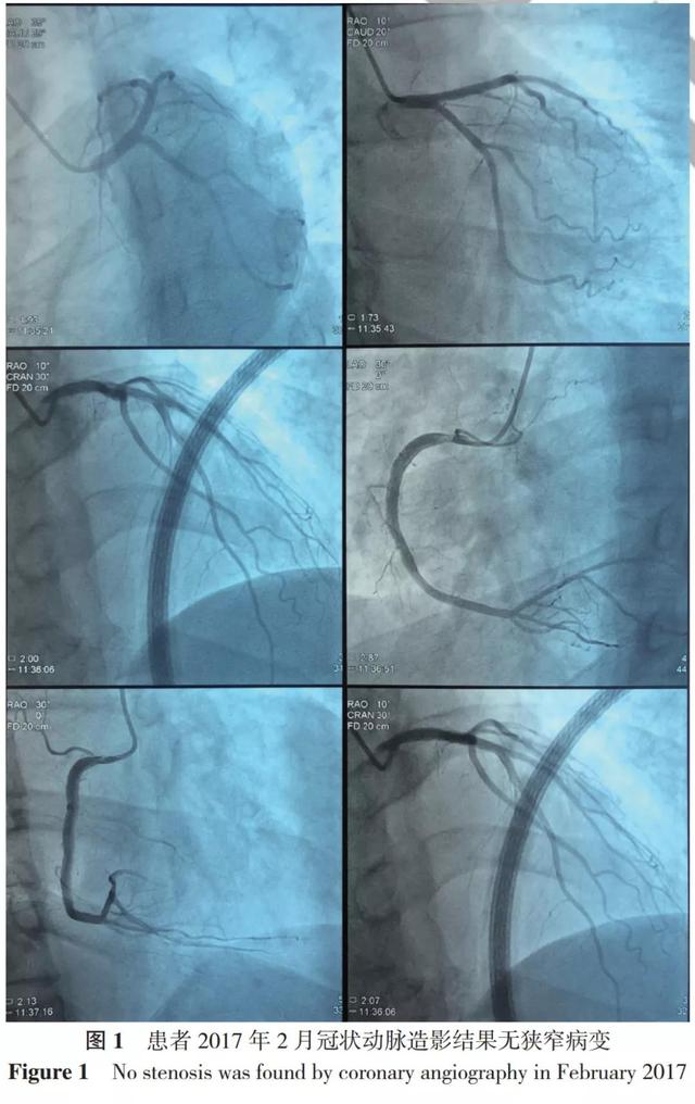 全科诊疗思路——冠状动脉无阻塞病变的变异型心绞痛患者的诊治过程