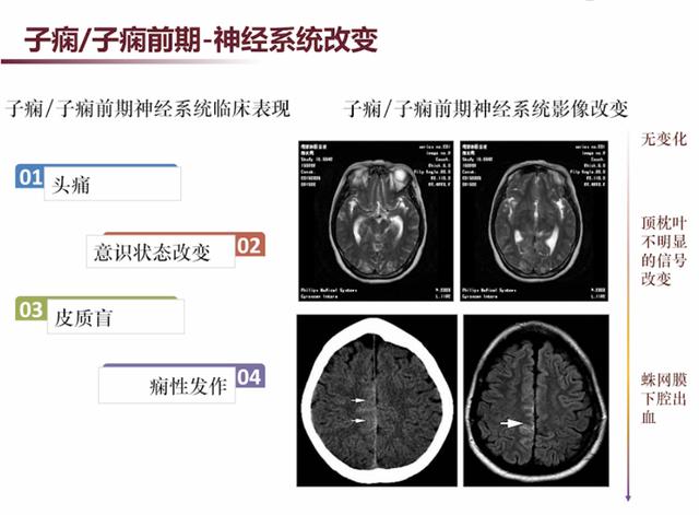 「超级宝妈」张馨：3类需要注意的妊娠合并神经系统疾病