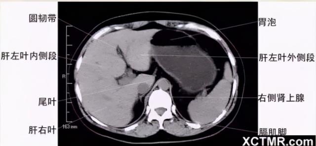影像解剖：胸、腹部、盆腔CT解剖