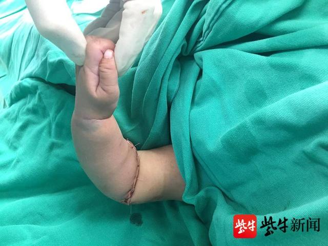手术|三个月大孩子断了胳膊，这是医生见过全国最小的不全断臂患者