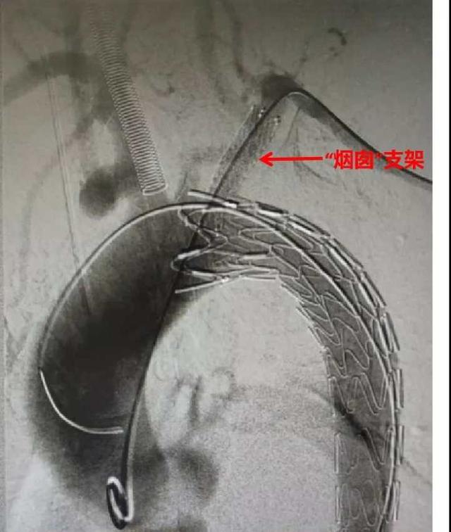 主动脉|“感觉死亡离我很近！”梦中惊醒，胸口撕开半米多长！这病突然发作、死亡率高