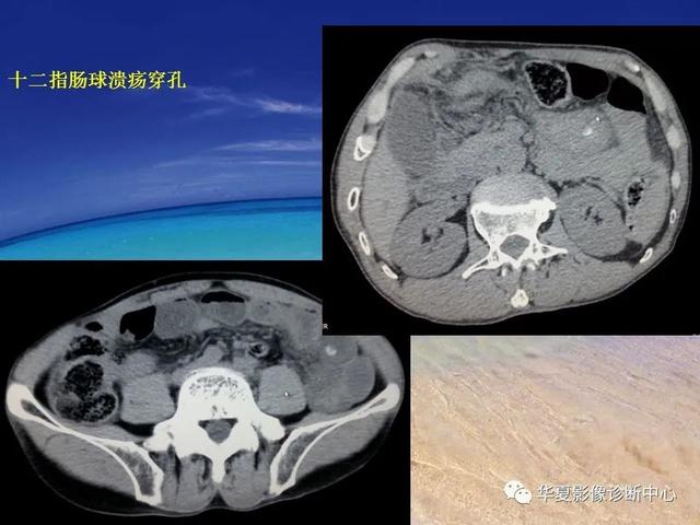 消化道穿孔的CT诊断