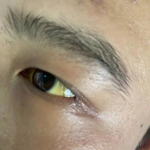 伤害|连续聚餐后，27岁小伙全身发黄、肝功能衰竭