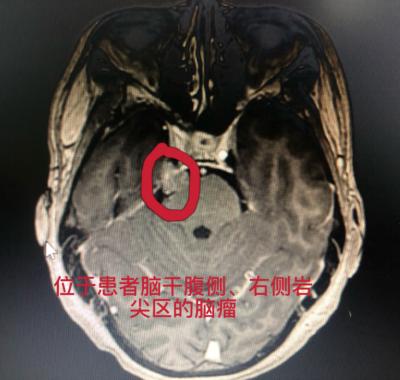 两次成功除瘤 老人感激送锦旗