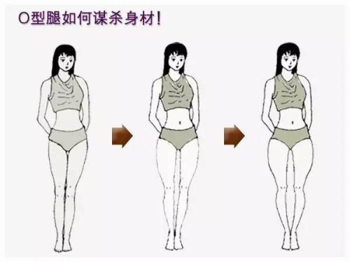 O型腿除了不好看还易患「膝骨关节炎」，难上加难如何才能避免？