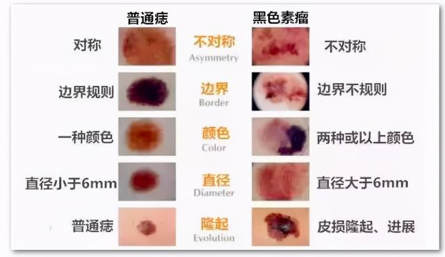 真心提醒：13%多次激光点痣者会发生癌变，你还敢随意点痣吗？