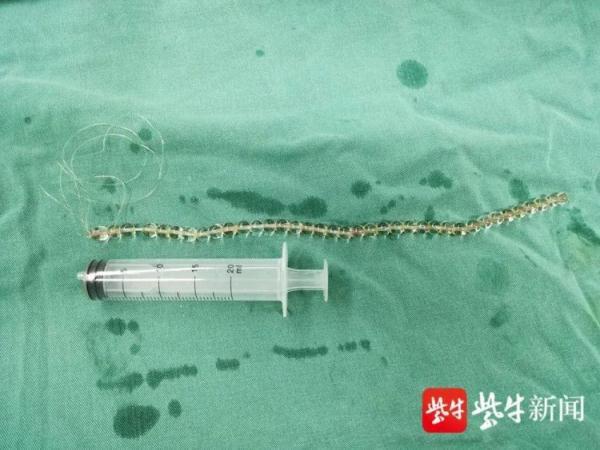 膀胱|小伙膀胱里有串“项链”，自己塞的……