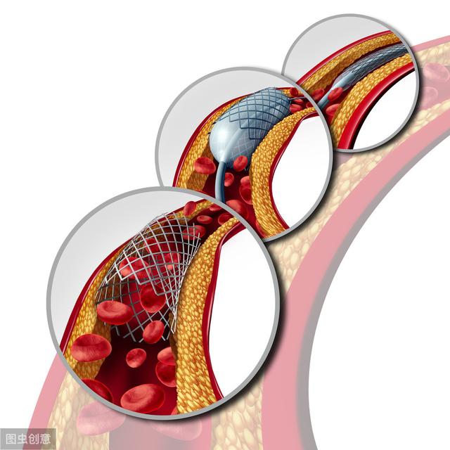 血管壁|冠脉放支架，斑块哪儿去了？