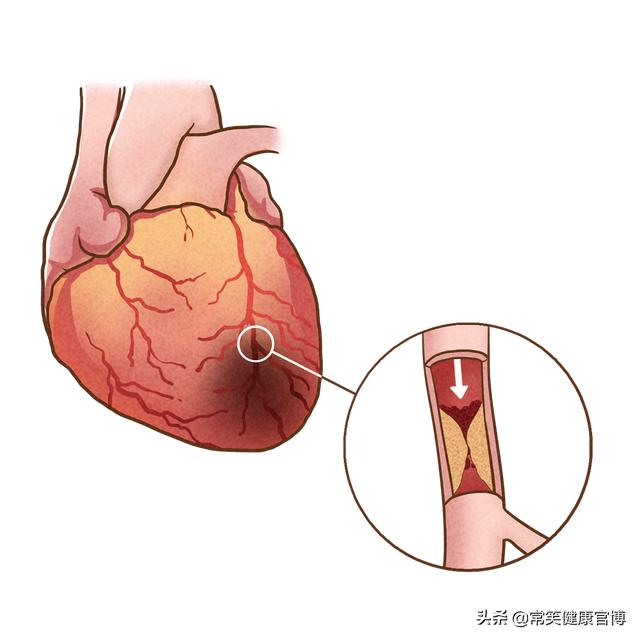 提早发现心肌梗死的5种征兆，关键时刻能救命