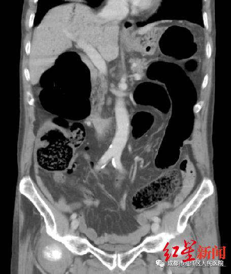 影像显示肝门静脉呈枯叶状！腹痛入院的78岁大爷遇上“死神之征”