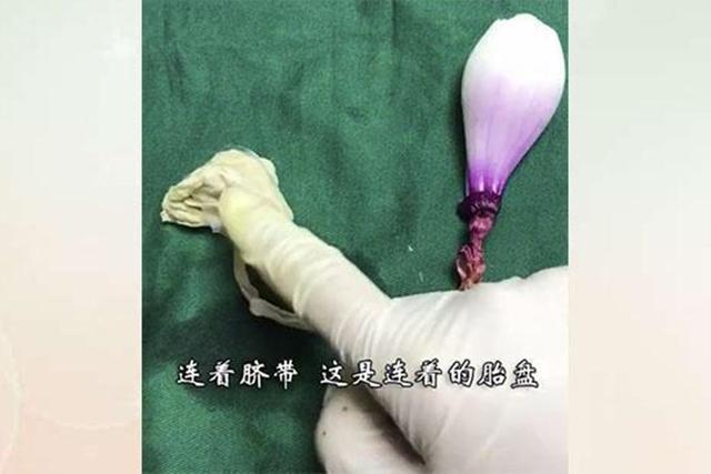 「画说育儿」网友给“洋葱”做剖宫产手术，过来人：又疼了一次！