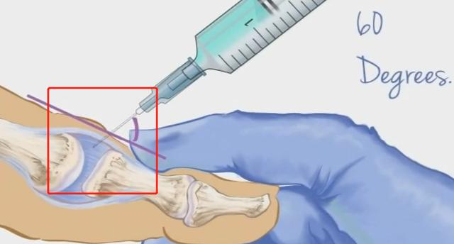 医生跟你谈谈:肩痛膝关节痛,该不该打封闭针?对身体有
