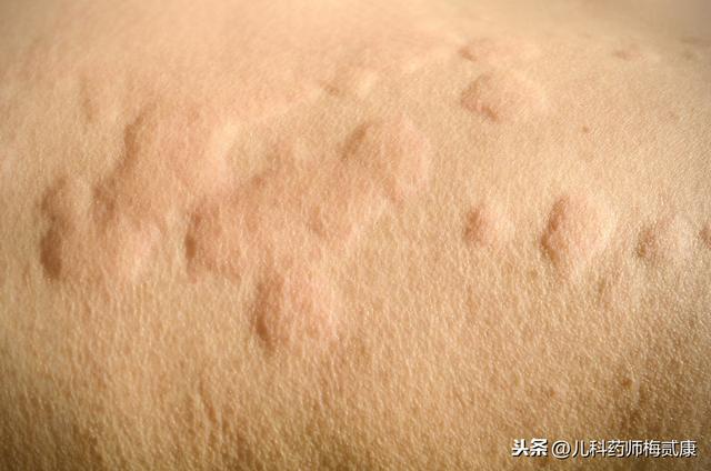 「你的育儿经」宝宝身上老起荨麻疹，每次痒的使劲抓挠，有没有好办法防治啊？