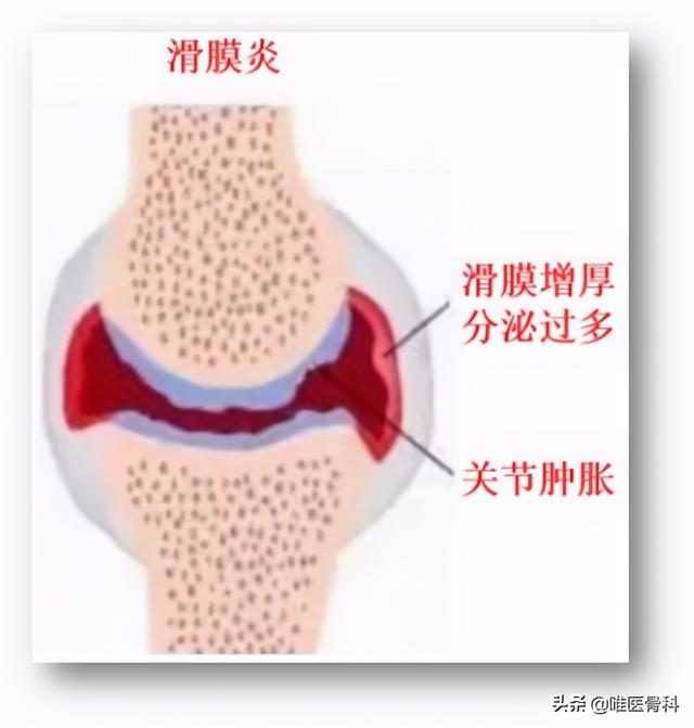 3 个方法，帮你判断是否得了「类风湿性关节炎」