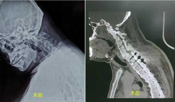 患者|山东大学齐鲁医院（青岛）为又一例颈椎后凸患者成功手术