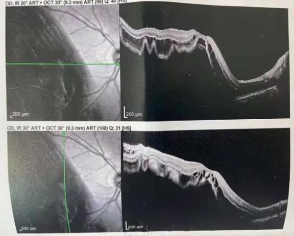 视网膜|母亲一个动作，17岁女孩眼睛看不清了！医生：错过黄金72小时
