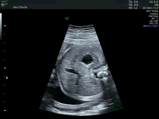 你的育儿经|胎儿下腔静脉缺如