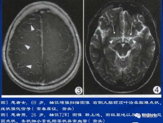 烟雾病的CT及MRI诊断