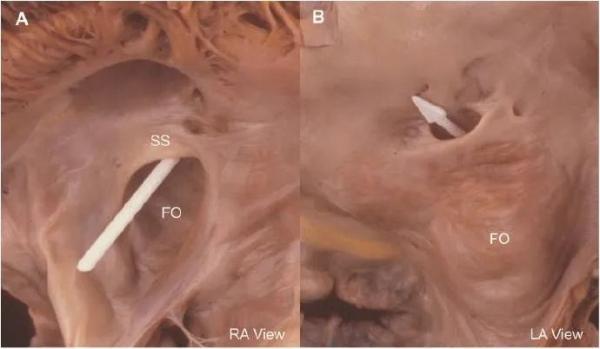 卵圆孔|攻坚克难｜青年脑梗死竟因心脏有个“洞