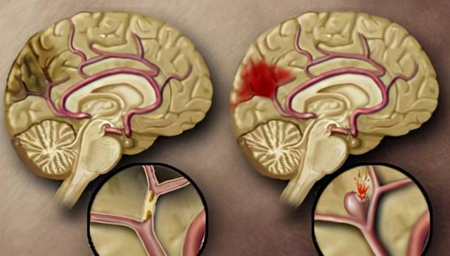 我国脑梗塞病人越来越多，美国却很少？最主要的原因是一种物质