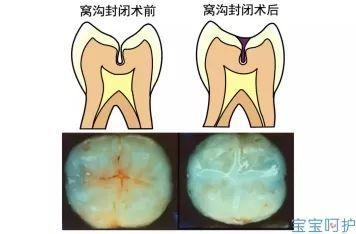 [小树丫]宝宝乳牙保卫战，不想有虫牙，要从日常生活习惯做起