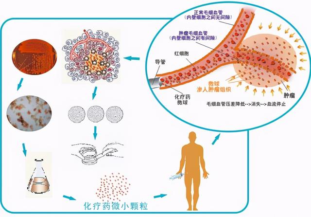 什么是肿瘤介入治疗？