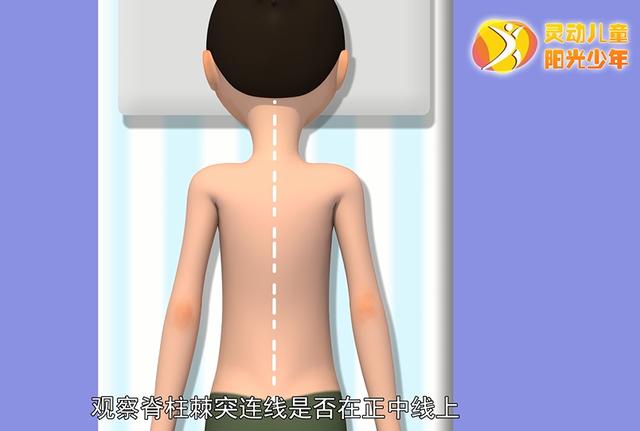 健康学堂|孩子高低肩，可能是病，这些脊柱侧凸自查方法，家长们一定要收藏
